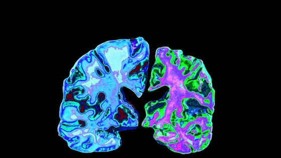 Alzheimerova choroba je jedním z nejčastějších neurodegenerativních onemocnění, dochází při něm k degeneraci mozkové tkáně (viz. foto vlevo zdravá, vpravo postižená mozková tkáň)